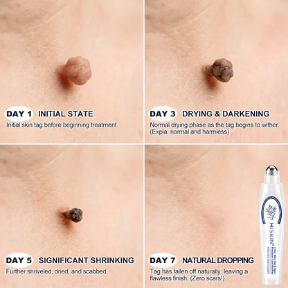 𝐇𝐈𝐒𝐊𝐈𝐍®👩‍⚕️ 𝟕-𝐃𝒂𝘆 𝐒𝗸𝐢𝐧 𝐓𝒂𝗴 & 𝐒𝐩𝙤𝐭 𝐄𝐫𝒂𝐬𝙚𝐫 Sans douleur & Scar-Free Advanced Imperfection Removal Rollerbtous Pen
