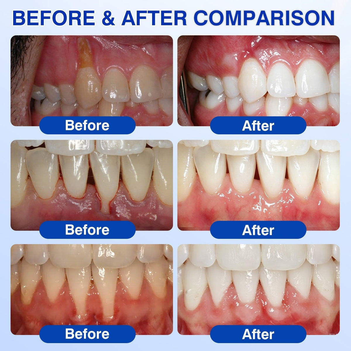 𝐇𝐈𝐒𝐊𝐈𝐍®👩‍⚕️🇺🇸🏅🦷🛡️HISKIN® GumRevive Periodontal Repair Gel