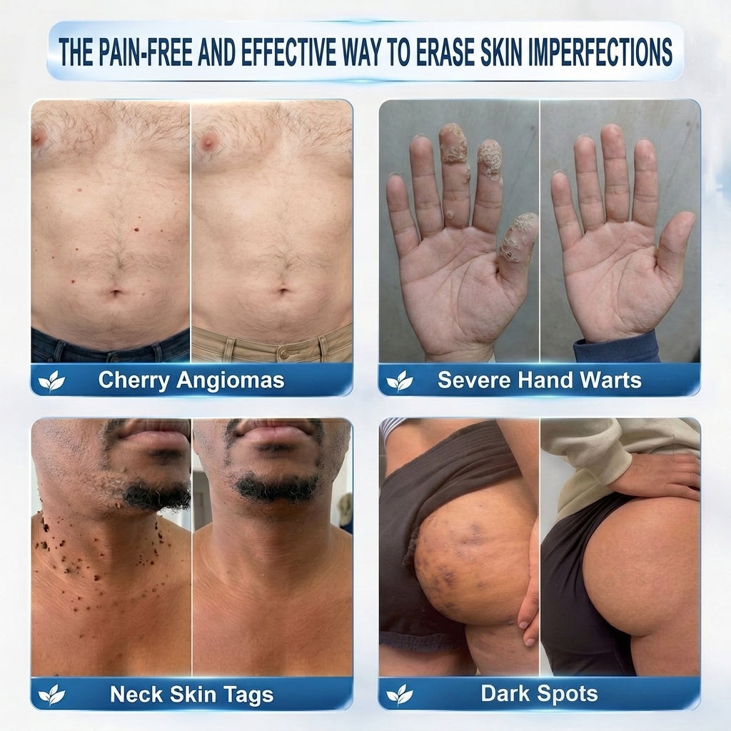 𝐇𝐈𝐒𝐊𝐈𝐍®👩‍⚕️ 𝟕-𝐃𝒂𝘆 𝐒𝗸𝐢𝐧 𝐓𝒂𝗴 & 𝐒𝐩𝙤𝐭 𝐄𝐫𝒂𝐬𝙚𝐫 Sans douleur & Scar-Free Advanced Imperfection Removal Rollerbtous Pen