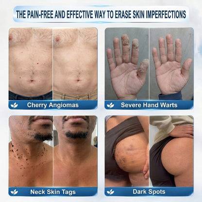 𝐇𝐈𝐒𝐊𝐈𝐍®👩‍⚕️ 𝟕-𝐃𝒂𝘆 𝐒𝗸𝐢𝐧 𝐓𝒂𝗴 & 𝐒𝐩𝙤𝐭 𝐄𝐫𝒂𝐬𝙚𝐫 Sans douleur & Scar-Free Advanced Imperfection Removal Rollerbtous Pen